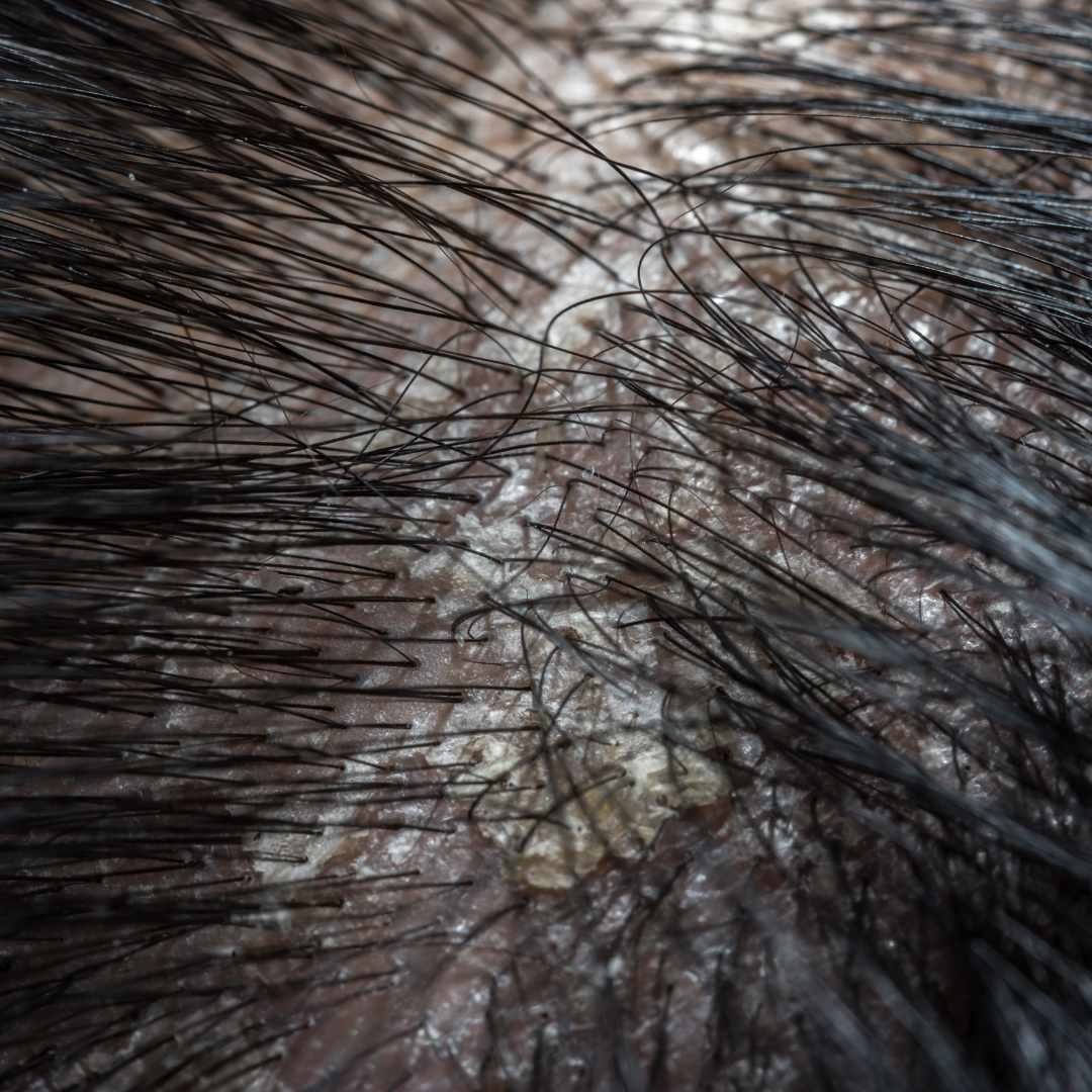 Shampoo til irriteret hovedbund