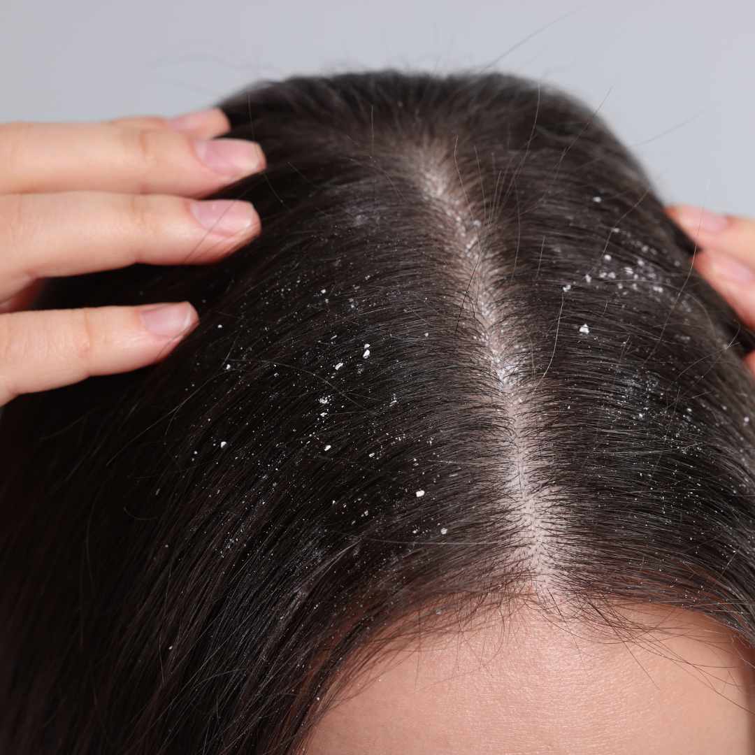 Shampoo mod skæl