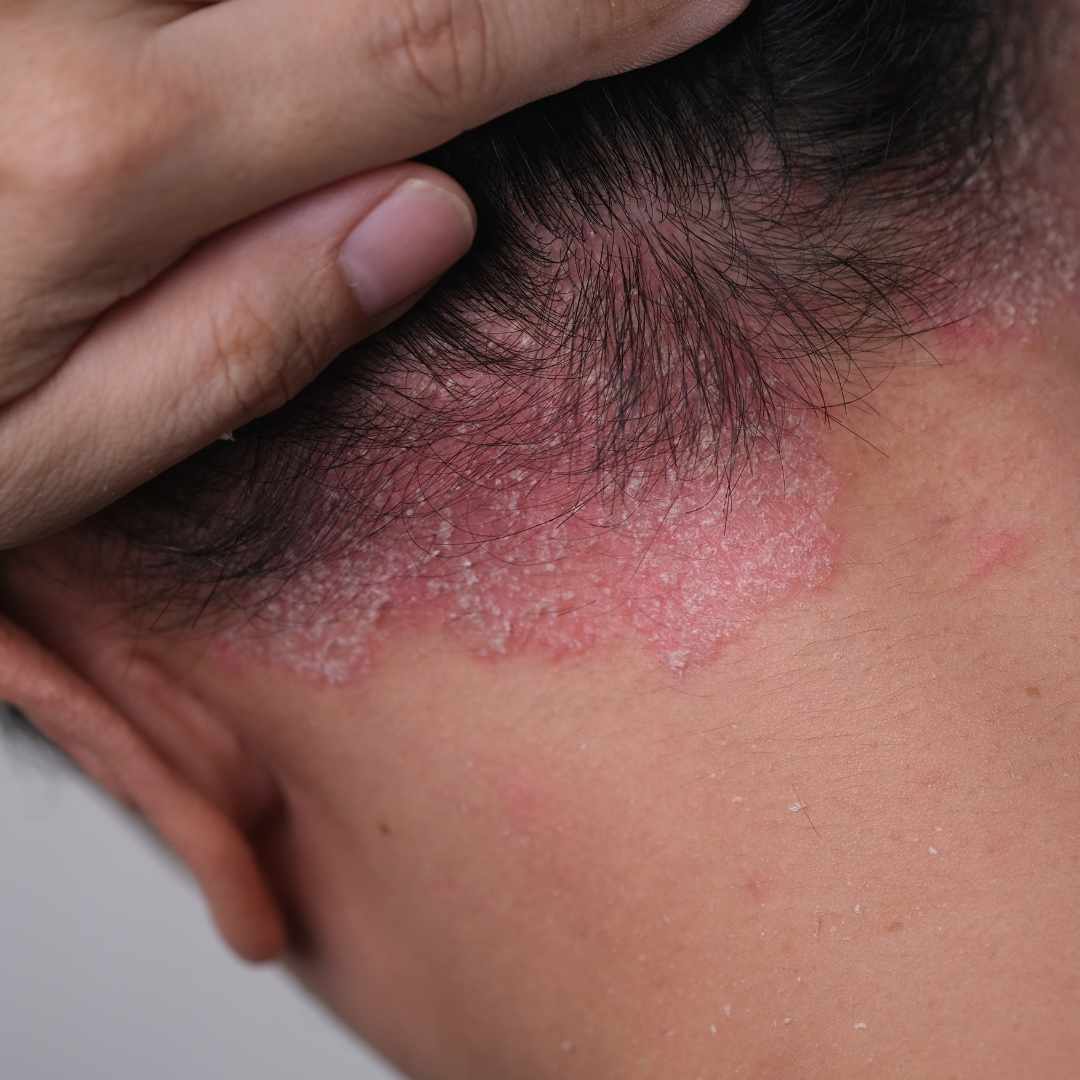 Shampoo mod psoriasis